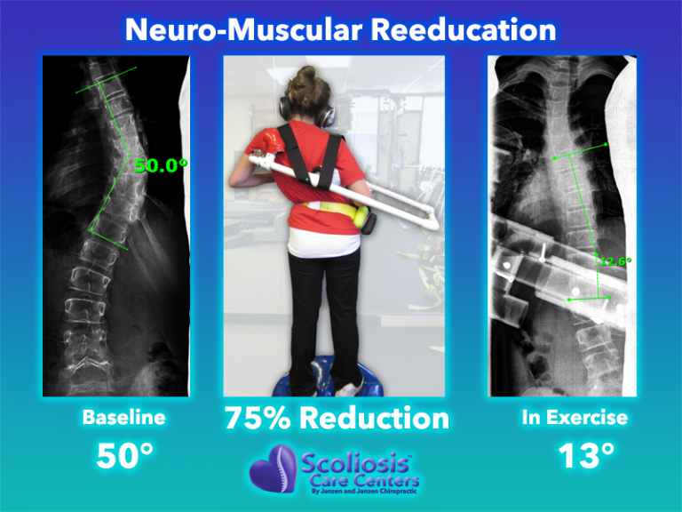 Scoliosis Exercises To Improve Posture Strength Scoliosis Care Centers