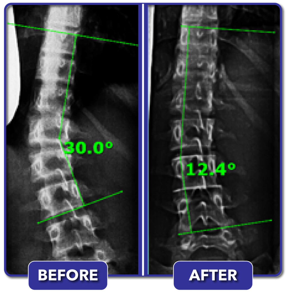 Scoliosis Before And After Treatment Results Scoliosis Care Centers