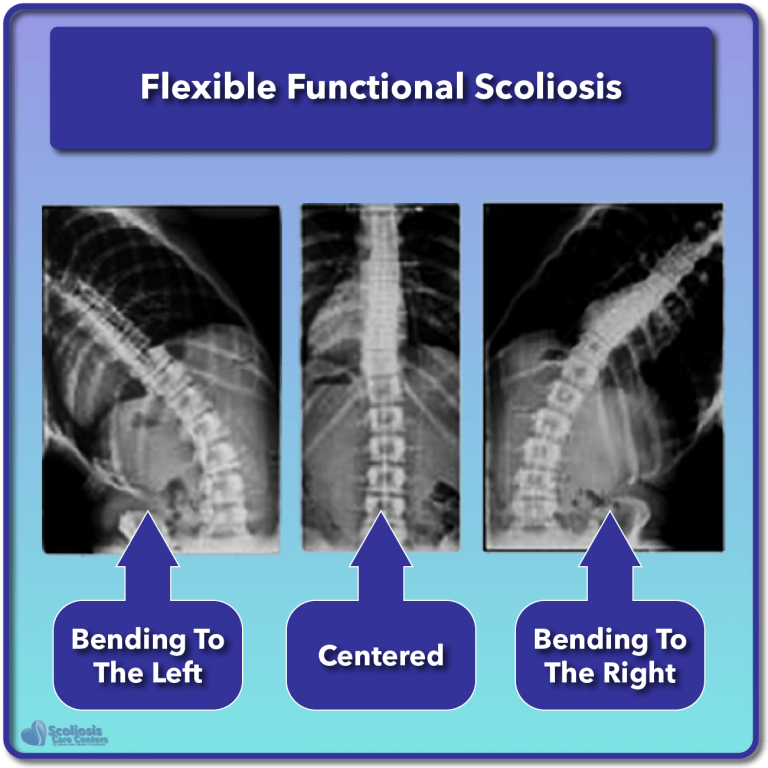 What Is Scoliosis Scoliosis Defined Its Causes Scoliosis Care Centers