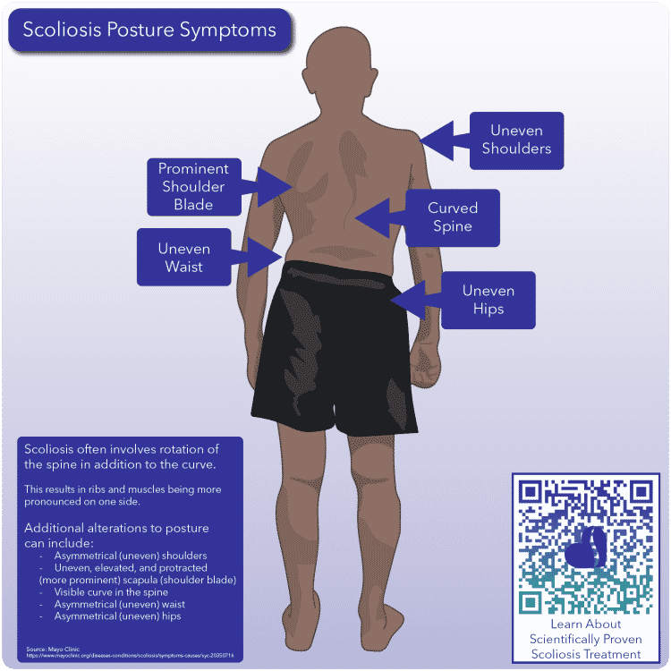 Scoliosis Posture Results Scoliosis Care Centers