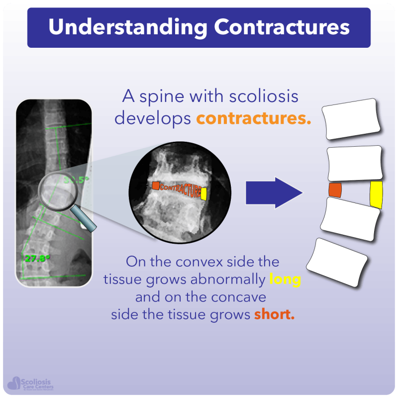 Scoliosis Flexibility Trainer Straighten Spines Without Surgery