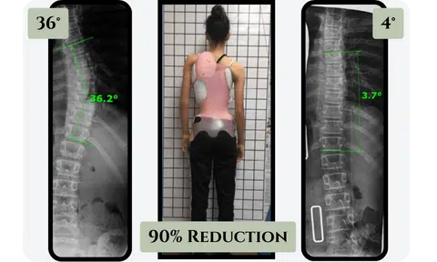 Scoliosis brace effectiveness - study results