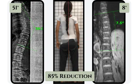 Scoliosis bracing comparison - correction outcomes