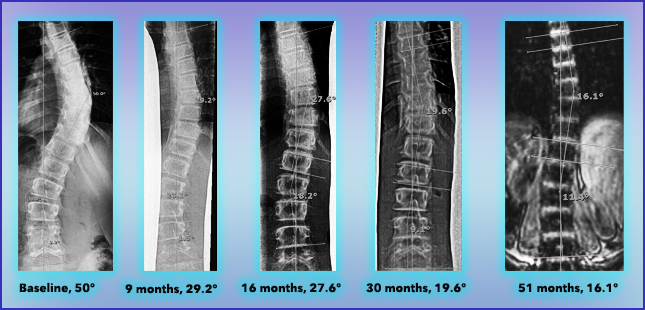 Scoliosis Success Stories Scoliosis Care Centers 0050