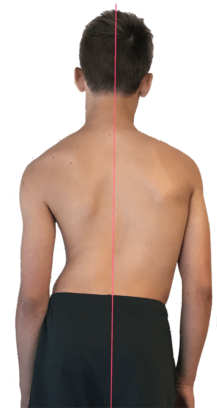 Non Surgical Scoliosis Treatment Scoliosis Care Centers 0919