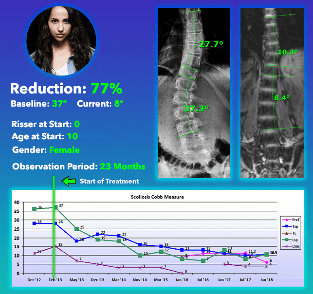 Scoliosis nonsurgical cure - scoliosis success story
