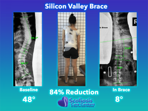Silicon Valley Scoliosis Brace Comparison-Scoliosis Care Centers 84% Reduction
