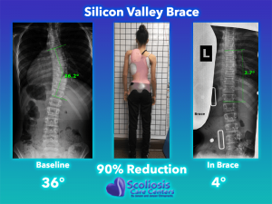 Silicon Valley Scoliosis Brace Comparison - 90% Curve Reduction