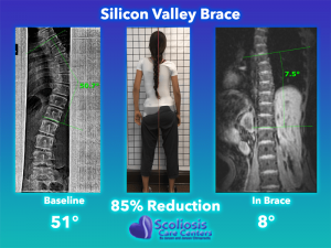 Silicon Valley Scoliosis Brace Comparison - 85% Curve Reduction