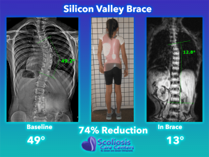 Silicon Valley Scoliosis Brace Comparison - 74% Curve Reduction