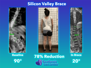 Scoliosis Brace - 78% Reduction Silicon Valley Brace from Scoliosis Care Centers