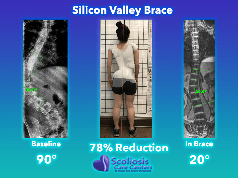 Silicon Valley Scoliosis Back Brace - Scoliosis Care Centers