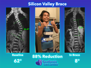 Silicon Valley Scoliosis Brace Comparison - 88% Curve Reduction