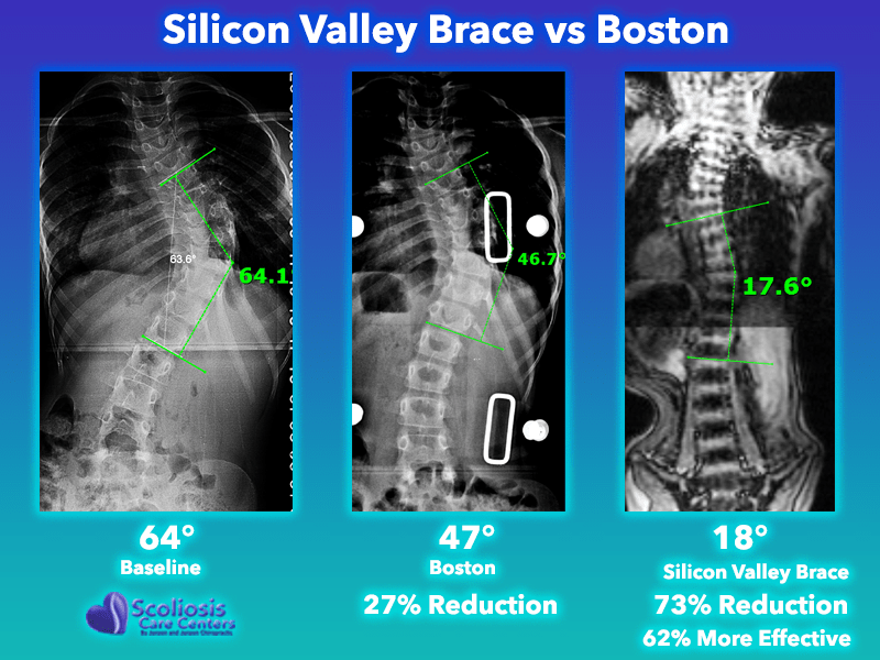 Boston Scoliosis Night Brace, Boston Re-alignment Braces, Products