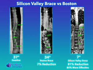 Silicon Valley Scoliossis brace comparison to Boston brace, 81% Reduction