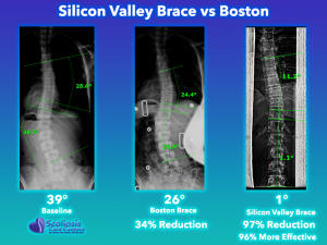 Silicon Valley Scoliossis brace comparison to Boston brace, SV brace is 97% more effective