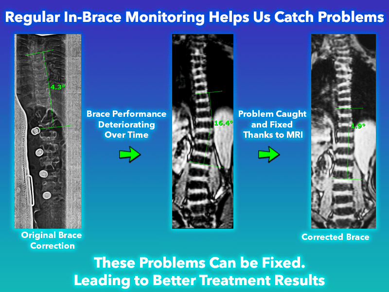 Standing MRI was used to Monitor and catch scoliosis progression to prevent it from worsening