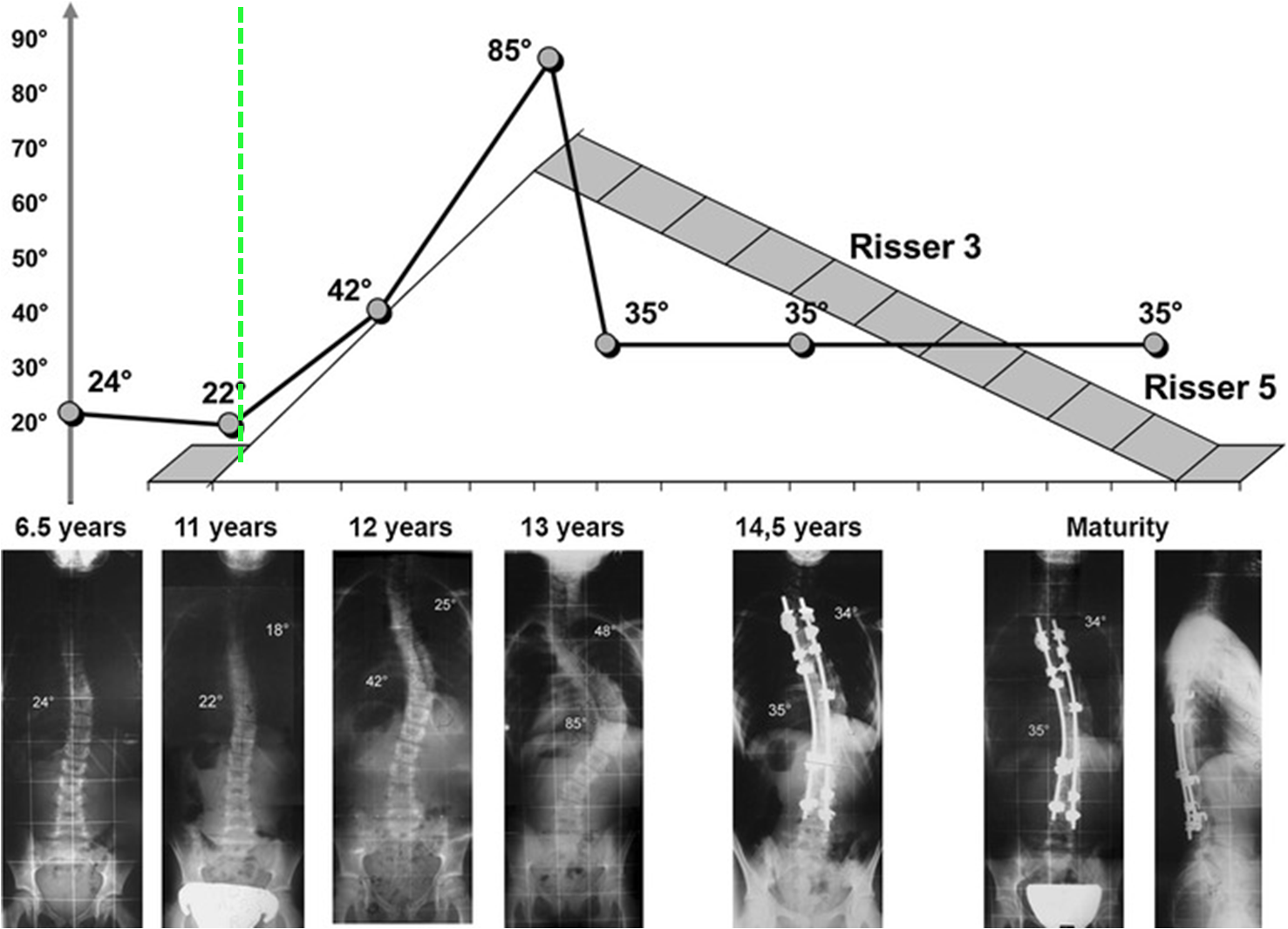 Rate of Growth is correlated with scoliosis curvature increase