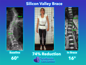 Scoliosis Brace - Back Brace for Scoliosis - Silicon Valley Brace 74% Reduction