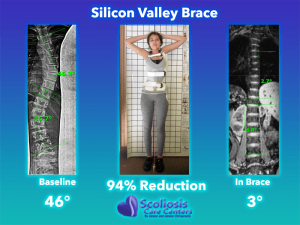 Scoliosis Brace - Back Brace for Scoliosis - Silicon Valley Brace 94% Reduction