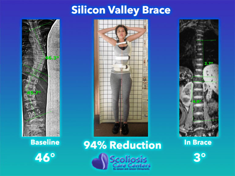 Silicon Valley Scoliosis Back Brace Scoliosis Care Centers