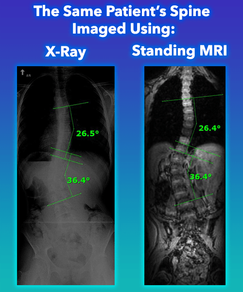 Scoliosis Treatment Monitoring with Standing MRI Scoliosis Care Centers