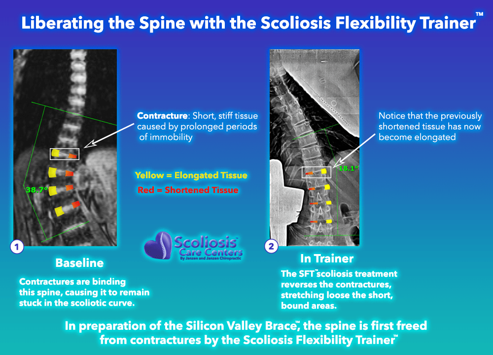 Liberating the Spine with the Scoliosis Flexibility Trainer, example of hyper correction of spinal contractures