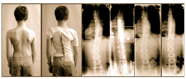 Scoliosis bracing study showing that a brace can reverse a scoliosis curve