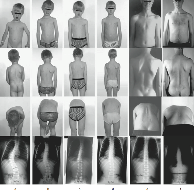 proof that a scoliosis brace used for a duration will prevent and reverse a scoliosis curve