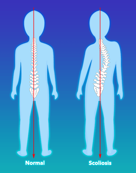What is scoliosis graphic image