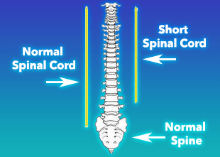 normal vs short spinal cord nerve tension illustration