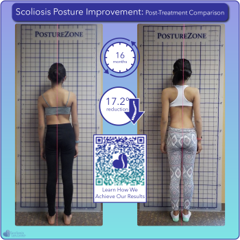 Scoliosis postural improvement with 17.2 degree curve reduction over 16 months of treatment
