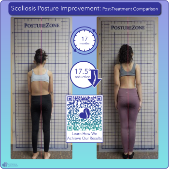 Scoliosis postural improvement with 17.5 degree curve reduction over 17 months of treatment