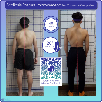 Scoliosis postural improvement with 20 degree curve reduction over 40 months of treatment