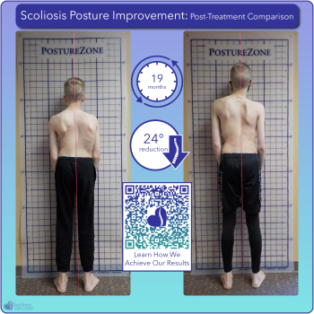 Scoliosis postural improvement with 24 degree curve reduction over 19 months of treatment