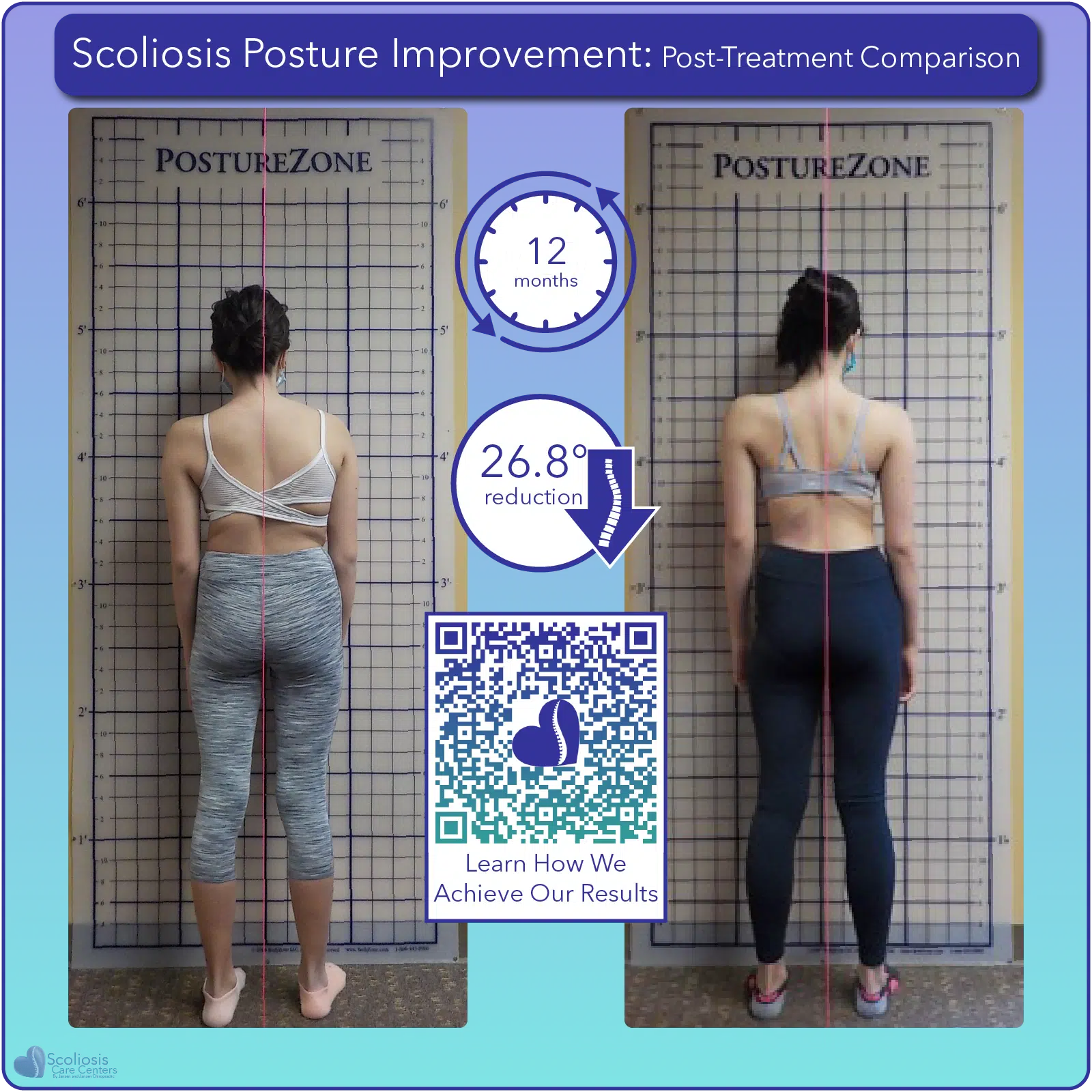 Scoliosis postural improvement with 26.8 degree curve reduction over 12 months of treatment