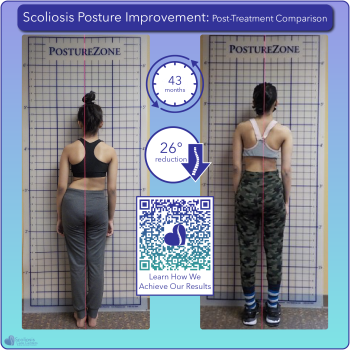 Scoliosis postural improvement with 26 degree curve reduction over 43 months of treatment