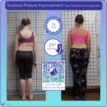 Scoliosis postural improvement with 29 degree curve reduction over 25 months of treatment
