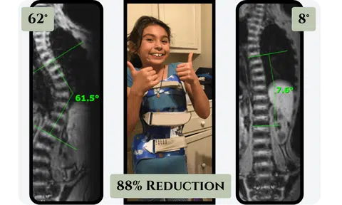 Hyper-corrective scoliosis bracing results