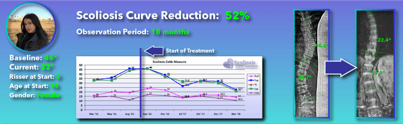Can You Cure Scoliosis Without Surgery Evidence Suggests You Can 