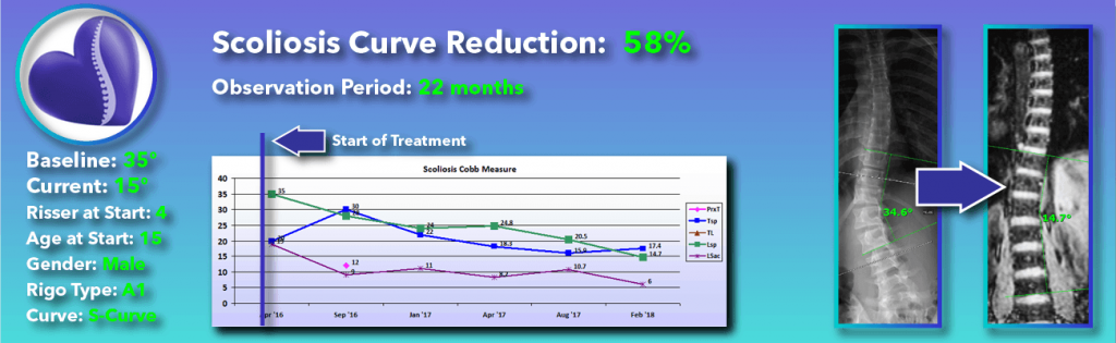 58 percent scoliosis reduction achieved through non-surgical methods