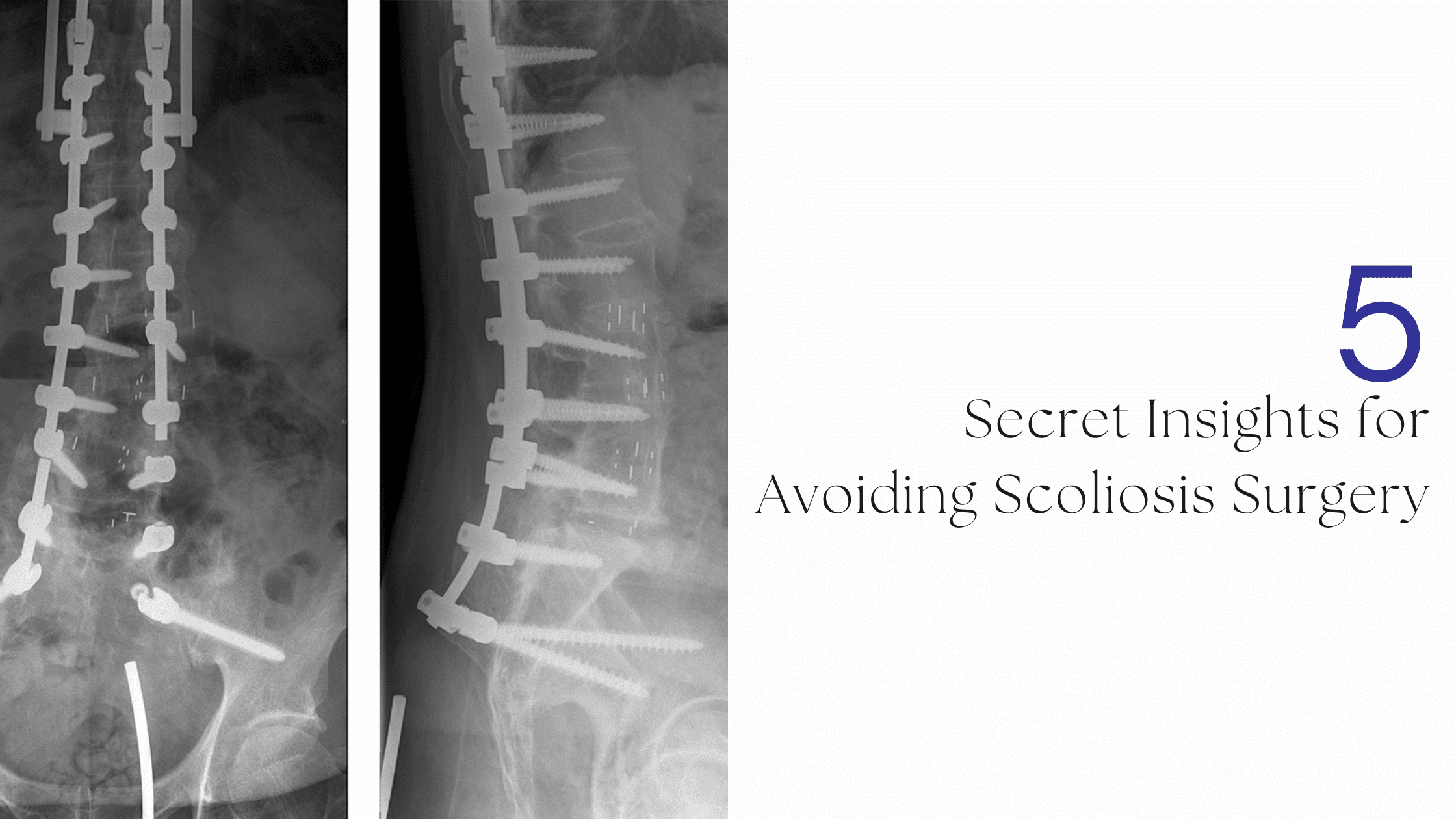 Secrets of Scoliosis Surgeons
