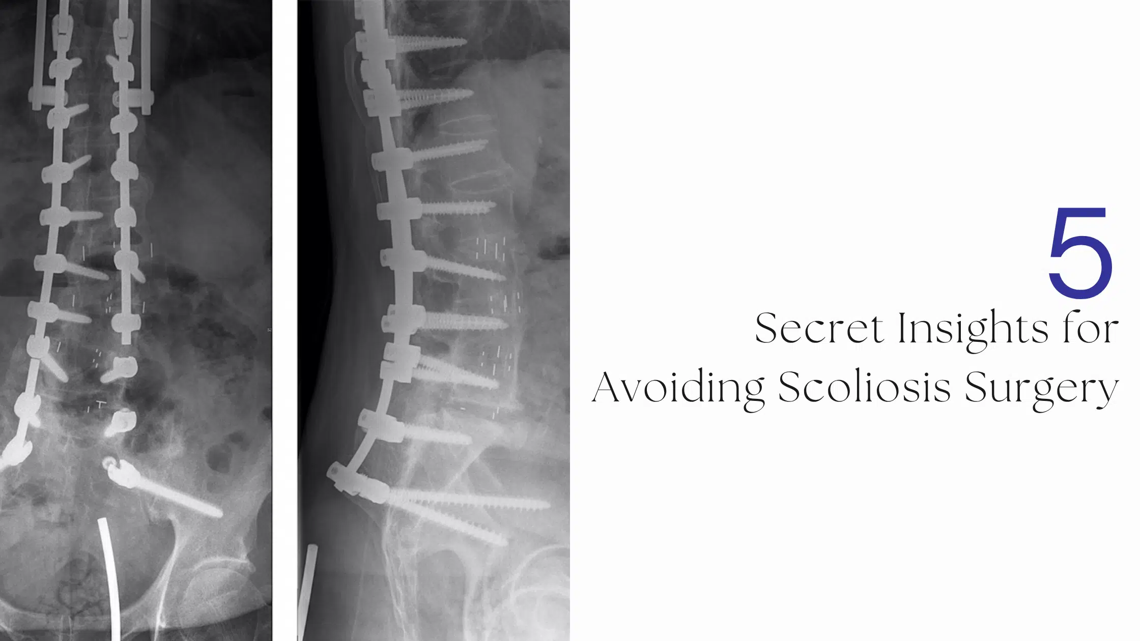 Scoliosis MRI
