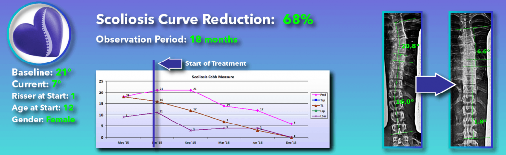 68 percent scoliosis reduction achieved through non-surgical methods