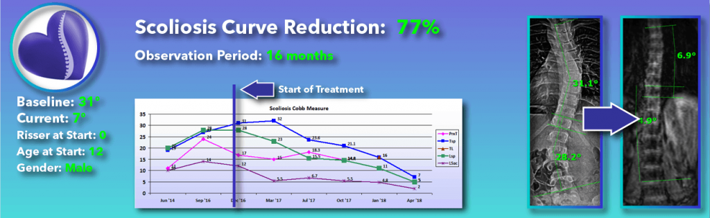 77 percent scoliosis reduction achieved through non-surgical methods