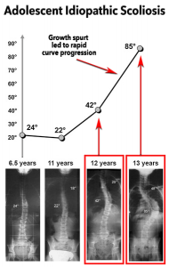 Growth spurt led to rapid curve progression of Adolescent Idiopathic Scoliosis