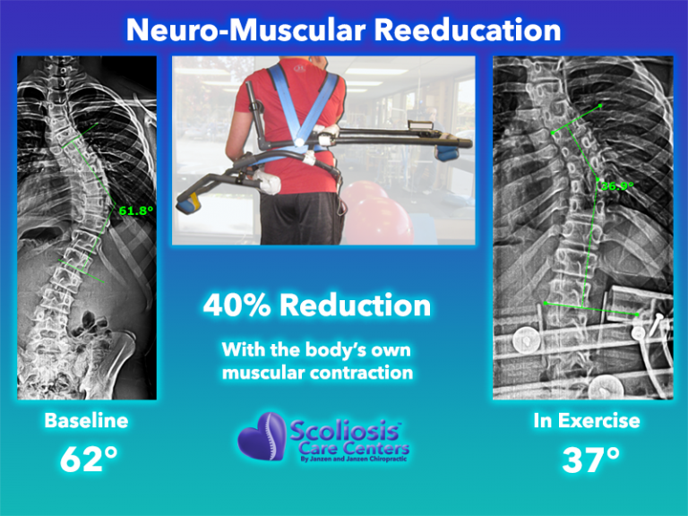 Scoliosis Exercises To Improve Posture And Strength Scoliosis Care Centers