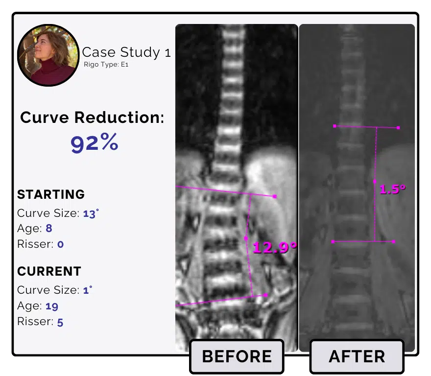 Before and after scoliosis treatment showing 13-degree curve reduction with detailed starting and current info, including percentage of curve reduction and comparison images.