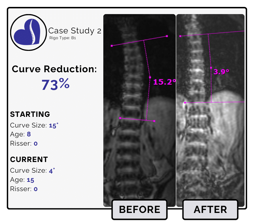 Before and after scoliosis treatment showing 15-degree curve reduction with detailed starting and current info, including percentage of curve reduction and comparison images.
