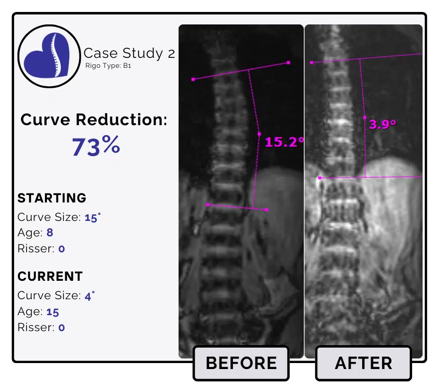 Before and after scoliosis treatment showing 15-degree curve reduction with detailed starting and current info, including percentage of curve reduction and comparison images.